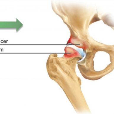 Dolor anterior de cadera: IMPINGEMENT y choque femoroacetabular.